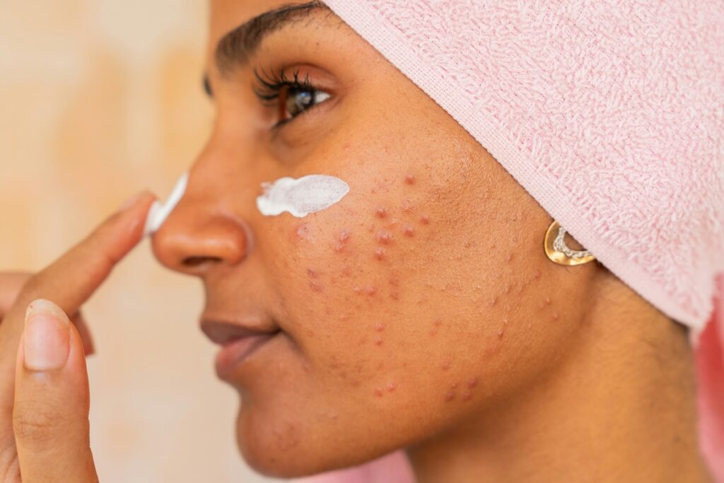 a woman applies benzene for her acne