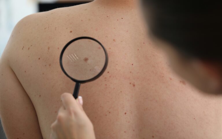 Dermatologist examining skin tags on a patient's back with a magnifying glass